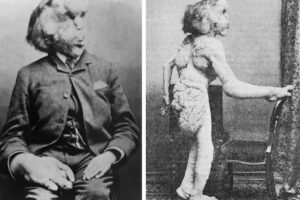 Elephant Man: La Belleza Interior en una Historia Impactante